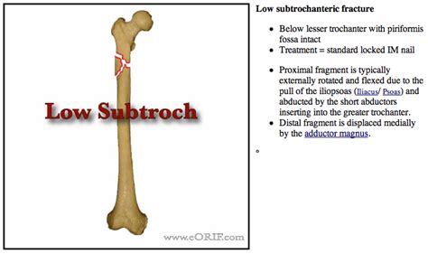 icd 10 fracture of femur|icd 10 femur fracture unspecified.